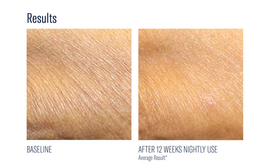 Alpharet Retinoid Body Cream